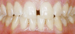 治療前の写真（歯と歯の隙間）
