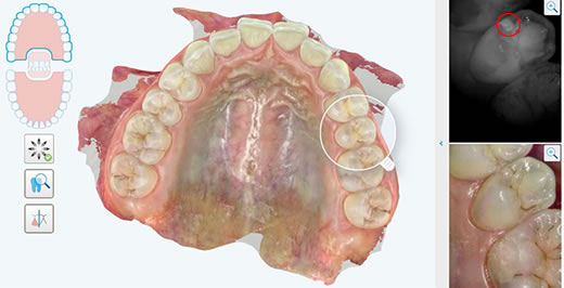 発見しづらい歯と歯の間のむし歯も、赤丸で示したように近赤外線（NIRI）で白く映ります